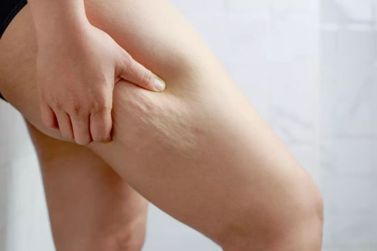 High-Definition-Lipedema-Surgery-Tunisie